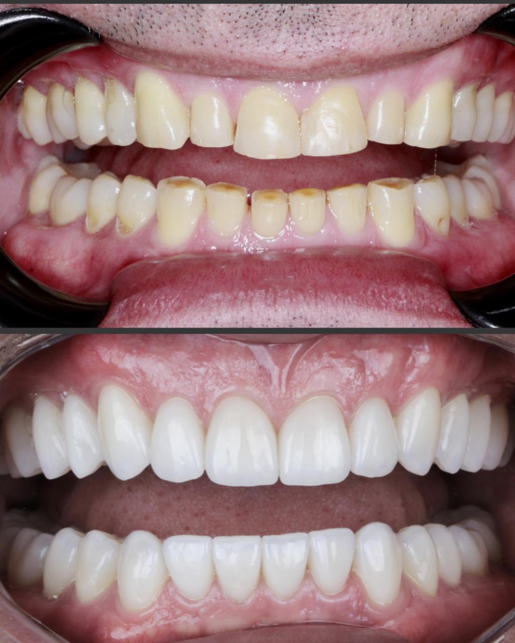 Antes e depois de lentes de contato dentais na SB Odontologia
