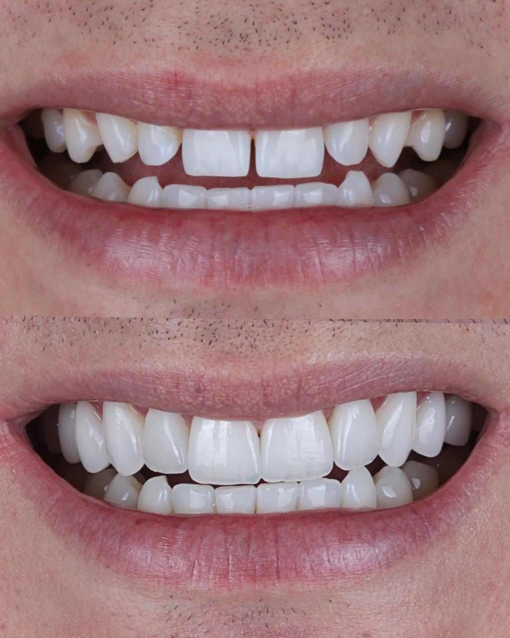 Antes e depois de lentes de contato dentais na SB Odontologia