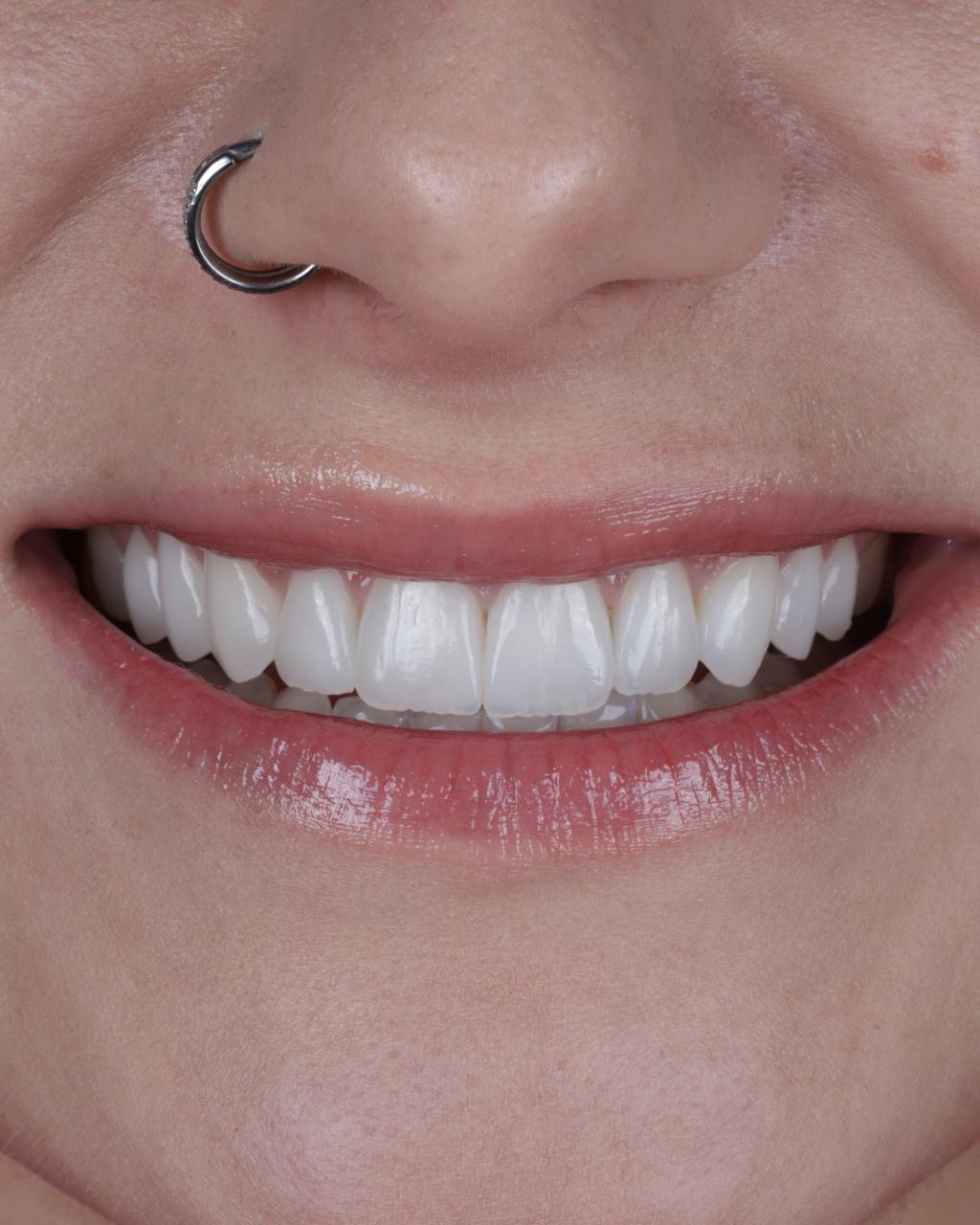 Antes e depois de lentes de contato dentais na SB Odontologia