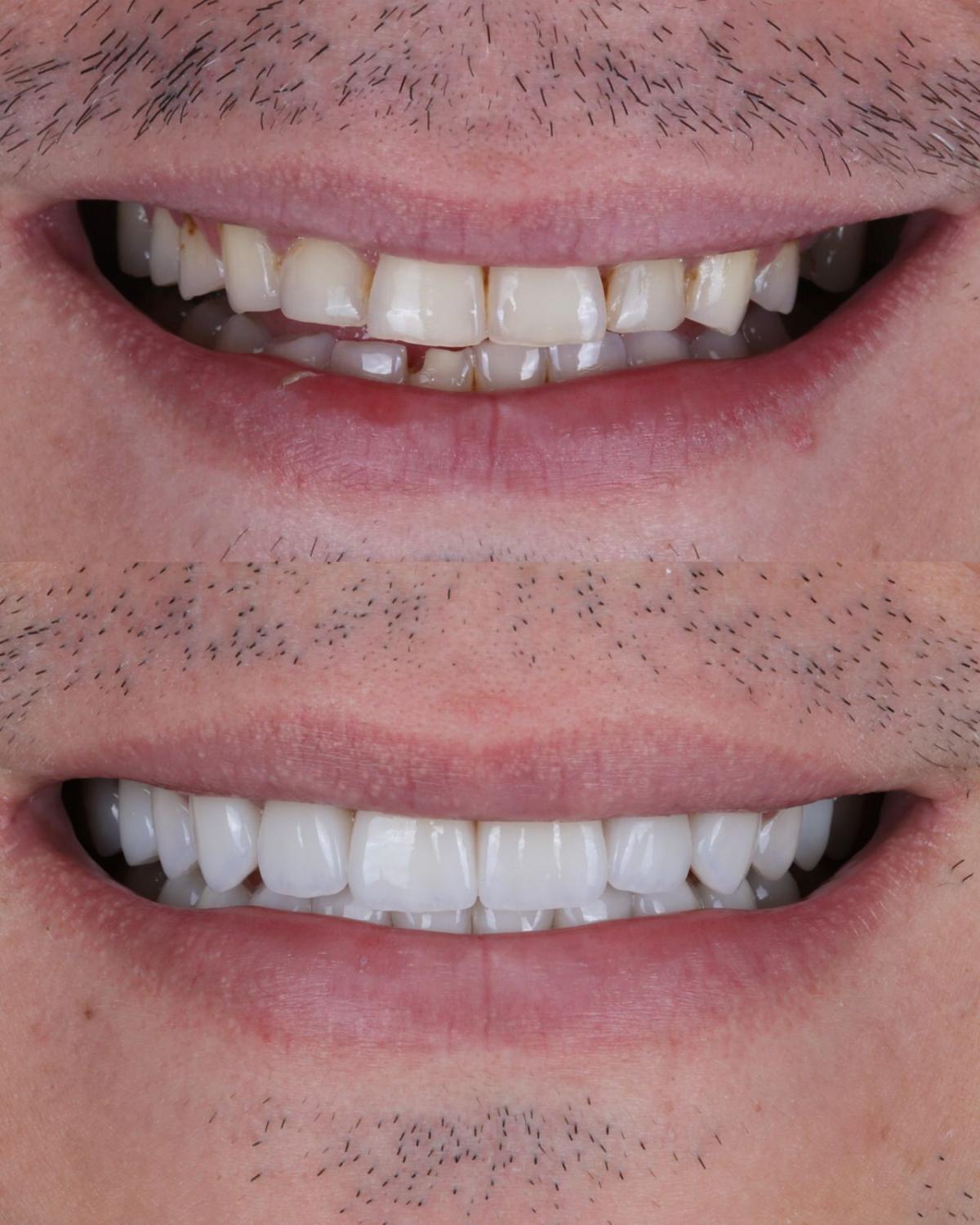 Antes e depois de implante dentário: dentes anteriores reabilitados
