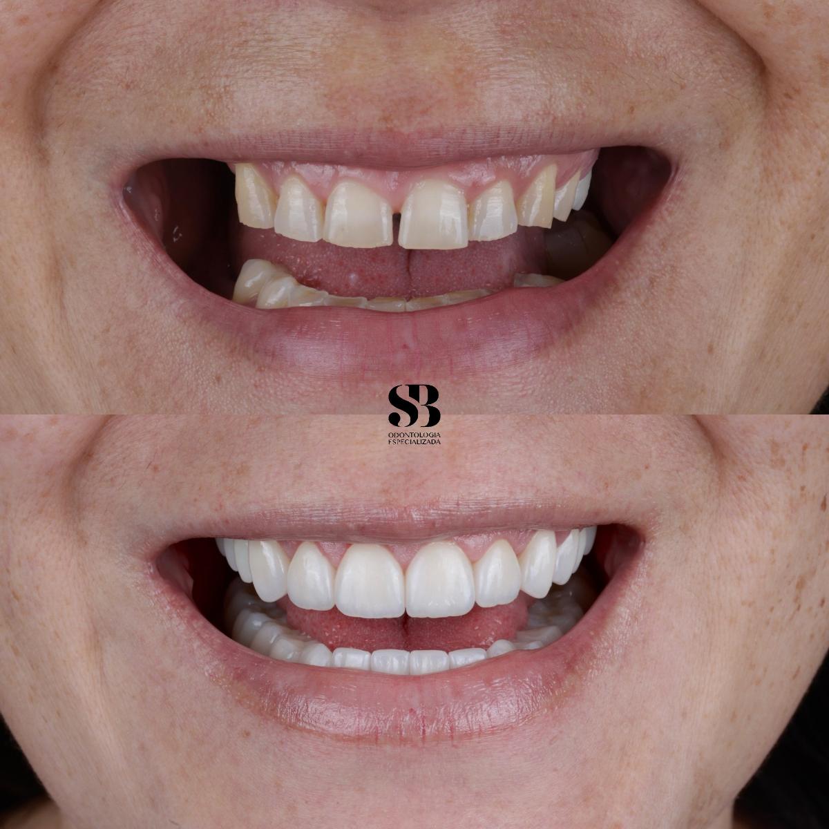 Antes e depois de implante dentário com recuperação do sorriso