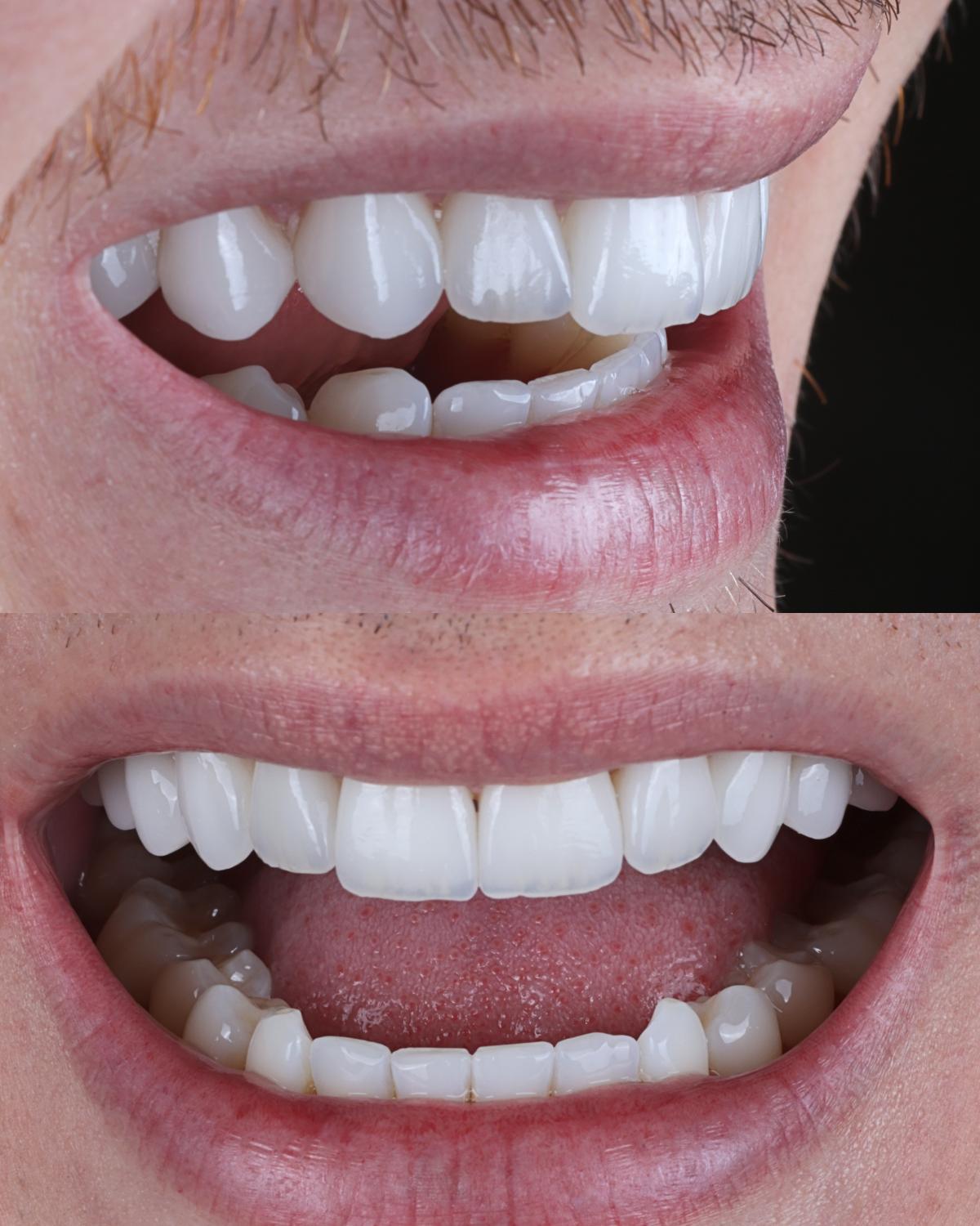 Antes e depois de lentes de contato dentais em dentes anteriores