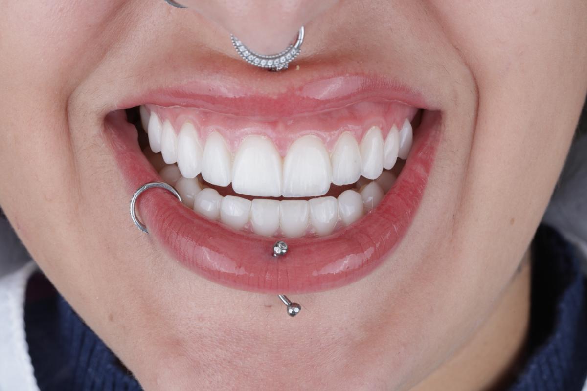 Resultado de lentes de contato dentais na SB Odontologia