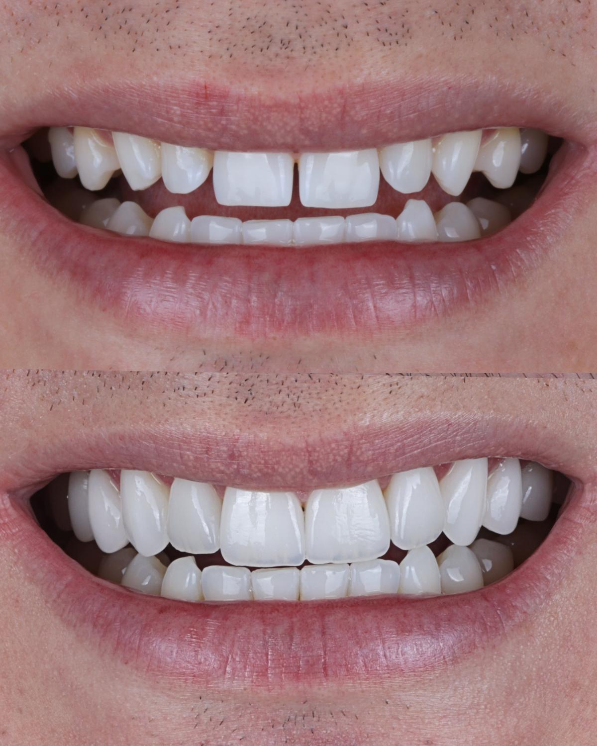Antes e depois de lentes de contato dentais com fechamento de espaços