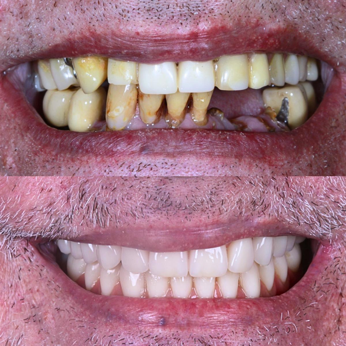 Antes e depois de protocolo sobre implantes em caso de perda dental avançada