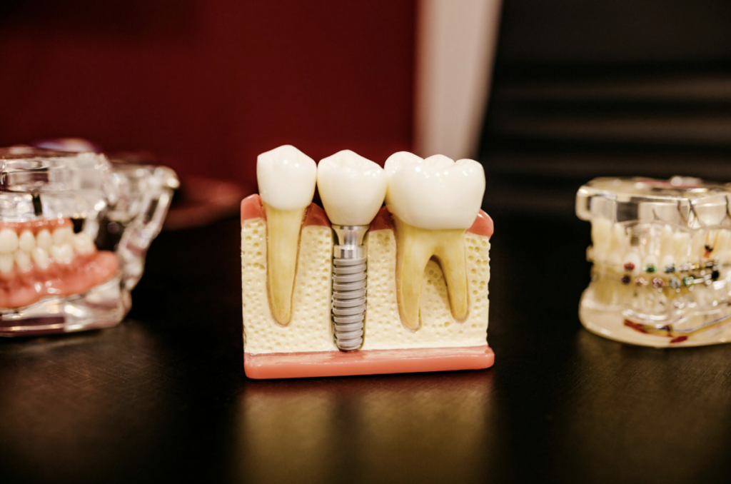 Guia de Implantes Dentários em São Paulo: Estética, Tecnologia e Preços